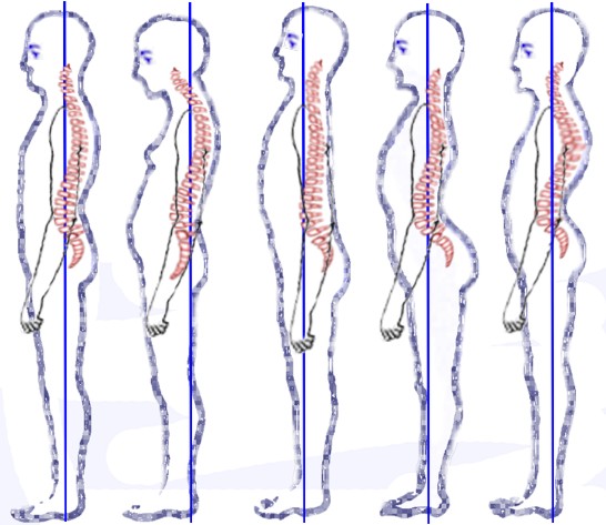 Posture_types_(vertebral_column)